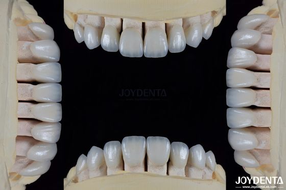 Keramiek voor natuurlijke esthetiek tandheelkundige fineer vlekwerend behoudt helderheid Sterke binding met tandglazuur voor een veilige pasvorm