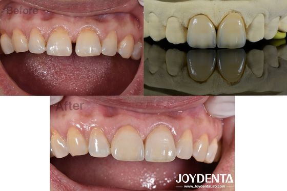 0.5 mm dikte tandheelkundige veneers Perfecte doorlaatbaarheid porseleinen veneers voor gap tanden