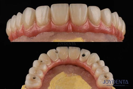kopen Ruwe oppervlakte tandheelkundige implantaten platform tandheelkundige bruggen met interne verbinding online vervaardiging