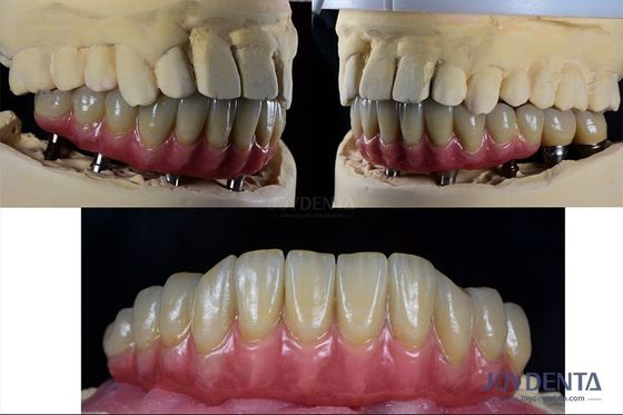 kopen Tandheelkundige reconstructie Meerdere tanden Implantat Titanium Prothese Intern online vervaardiging