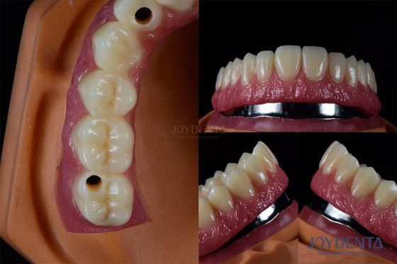 kopen Titanium Multiple Implantaten Tanden Interne Implantaten Kraakbestendig Op maat online vervaardiging