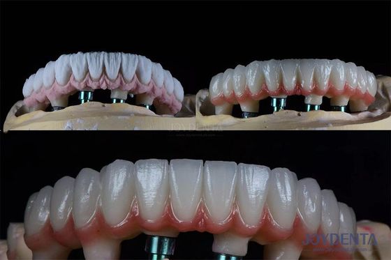 kopen 10 mm Multiple Tand Twee-stage tandheelkundige implantat kit voor endosese prothese kroon online vervaardiging