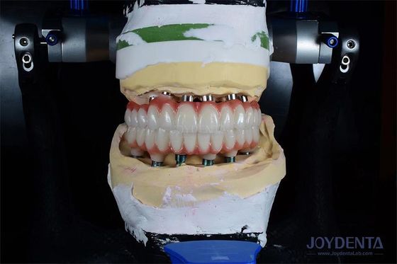 kopen 10 mm lang enkel tandimplantat Gamma bestraald voor optimale chirurgische resultaten online vervaardiging