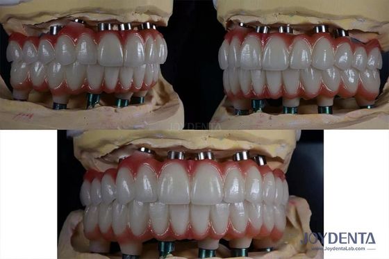 kopen 10 mm Titanium Meerdere Tanden Implantaten Ruwe oppervlakte Voor tandheelkundige restauratie online vervaardiging