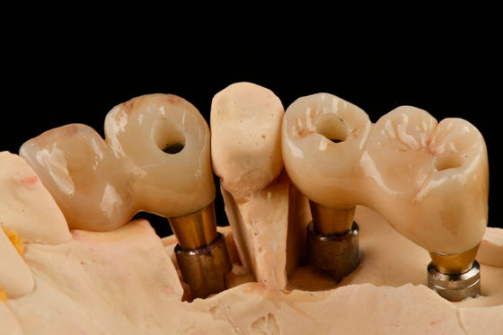 kopen Zelftap 3.0mm draad tandheelkundig titanium implantaat Geoptimaliseerde functionaliteit online vervaardiging