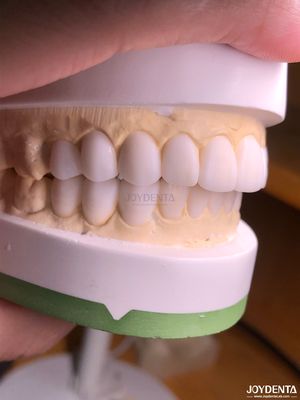 kopen Op maat gemaakte digitale diagnostische wax-ups voor natuurlijke tandanatomie replicatie online vervaardiging