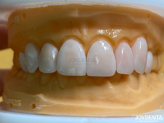kopen Lichte en gladde tandheelkundige fineers Vlekbestendigheid Langdurige duurzaamheid voor optimaal comfort online vervaardiging