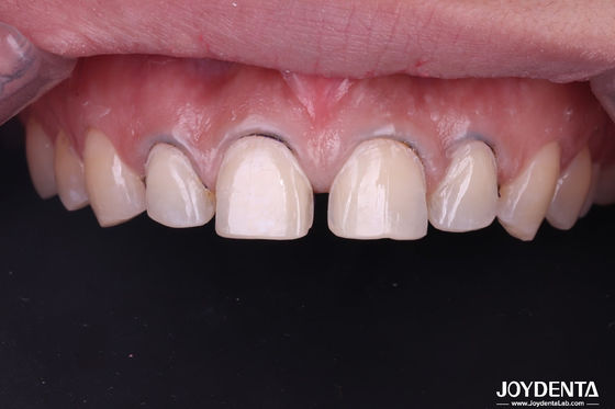 kopen Echt uitziende tandheelkundige porseleinen veneers perfect geschikt keramische tanden veneers voor de voortanden online vervaardiging