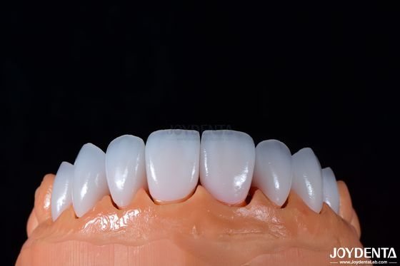 kopen 0.3-0.5 mm Dikte Emax porselein fineer voor hoogglanzende cosmetische tandheelkunde online vervaardiging