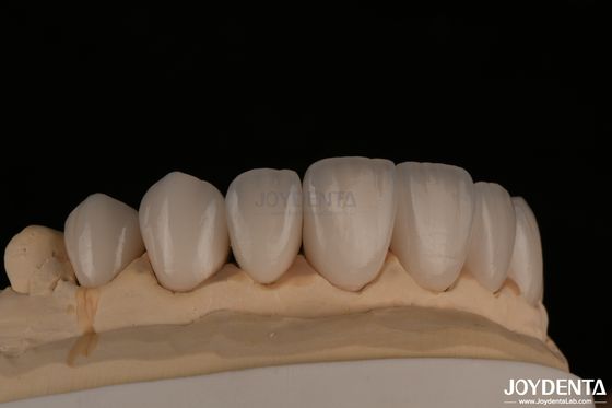 kopen Feldspatische natuurlijke uitstraling cosmetische fineer Precise fit Highly translucent online vervaardiging