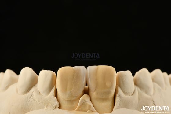 kopen 0.2 mm Dikte Microthin veneers Glas keramische tandheelkundige veneers voor voortanden online vervaardiging