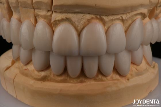 kopen 0.3 mm Dikte Ips Emax Veneers Keramische veneers Voorzijde Achterzijde Restauratie online vervaardiging