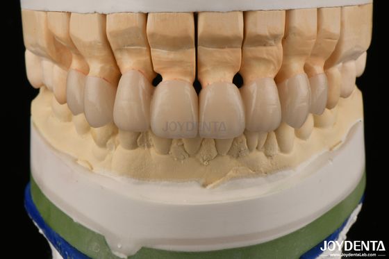 kopen Hoogtranslucent gelaagd zirconia kronen bruggen tandheelkundige restauraties levensecht uiterlijk online vervaardiging