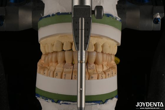 kopen Hoge esthetiek porseleinen gelaagd tandheelkundig zirconia voor implantatenherstel online vervaardiging