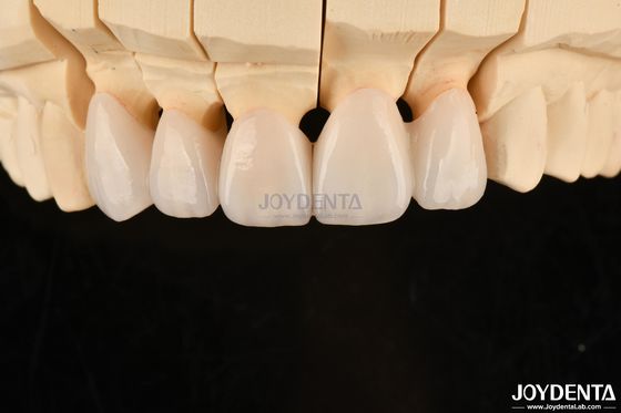 kopen Zeer aanpasbare gelaagde circonia tandkronen en bruggen Langdurige oplossing online vervaardiging
