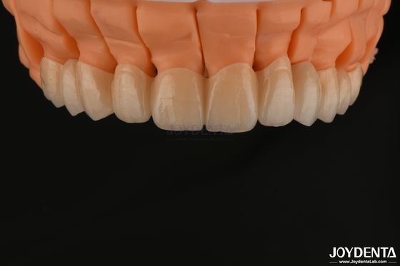 kopen Hoge esthetiek gelaagde zirconia enkelvoudige kronen bruggen implantaat voor tandheelkundige restauraties online vervaardiging