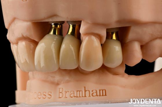 kopen Precisie tandheelkundige implantaten Kroon en brug Perfecte oplossing voor een esthetisch aangename glimlach online vervaardiging