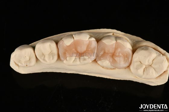 kopen Natuurlijke gepolymeriseerde porseleinen tandheelkundige inlay Onlay voor tandherstel online vervaardiging
