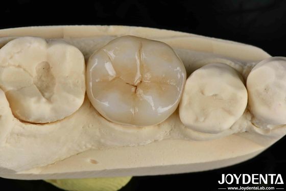 kopen Kleefcementatie Zirconia tandheelkundige inleg en onlays natuurlijke uitstraling online vervaardiging