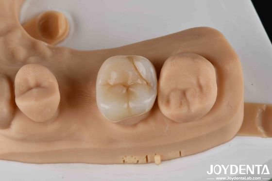 kopen Hoge sterkte Zirconia tandheelkundige inleg en onlays voor tandherstel online vervaardiging