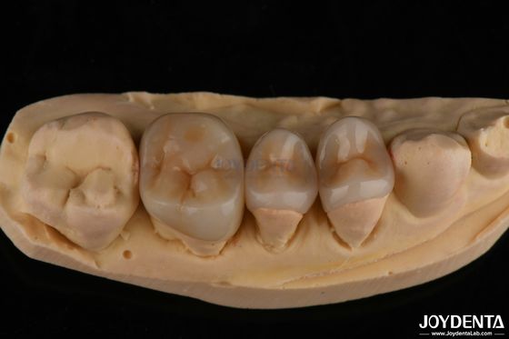 kopen Natuurlijke Emax Inlay Onlay Langdurige tandheelkundige restauratie 0,5 mm 1 mm 1,5 mm Dik online vervaardiging