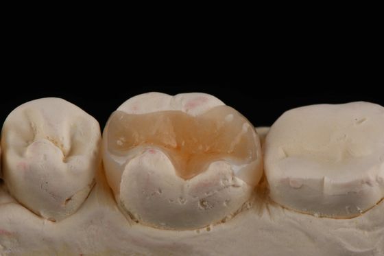 kopen E Max Materiaal Inlay en Onlay in de tandheelkunde Esthetische restauratie Langdurig online vervaardiging