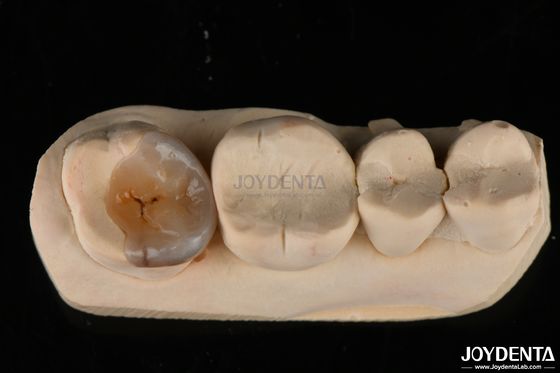 kopen Custom natuurlijke Emax tandheelkundige inlays en onlays voor tandherstel online vervaardiging