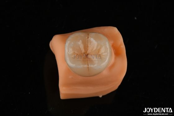 kopen 0.5mm Vlekbestendig Emax Inlay Onlay Accurate Fit Voor Tandheelkundige Restoraties online vervaardiging
