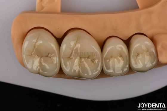 kopen Premium gouden en palladium legering tandheelkundige kronen voor een grotere duurzaamheid online vervaardiging