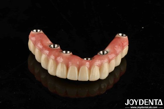 kopen Tandheelkundige titanium-malo-implantatiebrug met traditionele en moderne technieken online vervaardiging