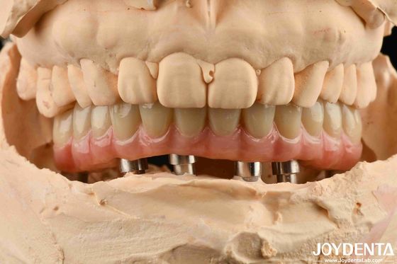 kopen Aesthetische Titanium Malong Hybride Tandheelkundige Implantatie Brug Voor Tandheelkundige Perfectie online vervaardiging