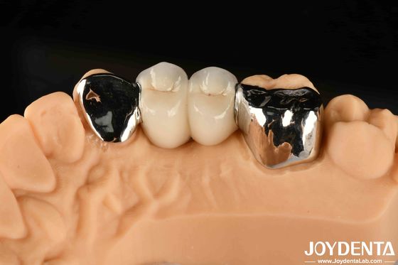 kopen Metalen tandheelkundige Maryland gebonden brug goede remedie voor orale klinische reparatie online vervaardiging