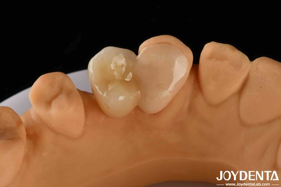 kopen Emax Maryland Veneer Clinical Bonding Adhesion voor kleurmatching tandheelkundige reparatie online vervaardiging