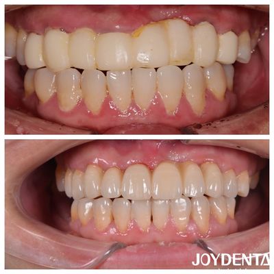kopen Natuurlijke kleur meerlagige tandheelkundige zirconia bruggen voor een optimale patiënt ervaring online vervaardiging