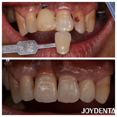kopen Gepersonaliseerde tandheelkundige Zirconia veneers Natuurlijke kleur Levensgetrouwe restauraties Tandverschijning online vervaardiging
