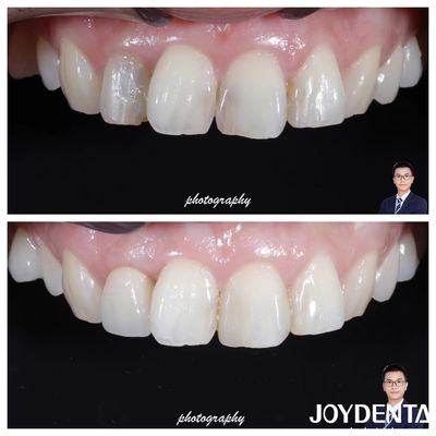 kopen Esthetiek Translucentie Zirconia kronen Natuurlijk uitziende hoge breukbestendigheid online vervaardiging