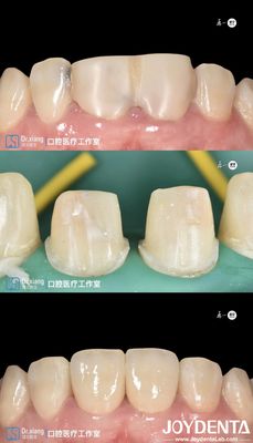 kopen Perfecte tanden Zirconia tandkronen met CAD CAM-systemen voor precisieproductie online vervaardiging