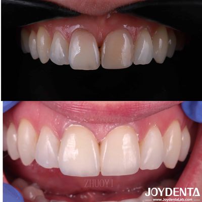 kopen Glanzige oppervlakte tandheelkundige veneers voor scheve tanden, aangepaste cosmetische porseleinen veneers online vervaardiging
