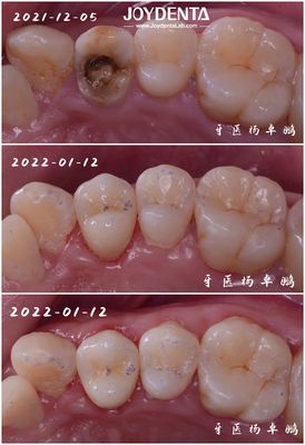 kopen Accurate Fit Dental Porcelain Inlay Restoration van beschadigde tanden voor volwassenen en kinderen online vervaardiging