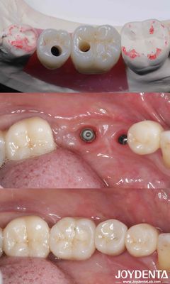 kopen Zylindrische tandheelkundige implantaten van titanium 10-16 mm lengte Hex verbinding online vervaardiging
