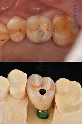 kopen Titanium volledige boog tandheelkundige implantaten Prothese platform 4.1mm Voor uitzonderlijke duurzaamheid online vervaardiging