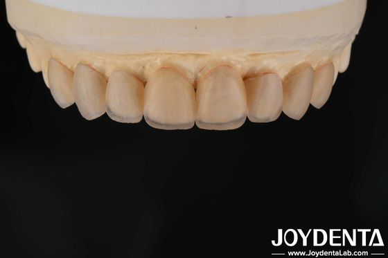 kopen Natuurlijke verschijning Glas keramische veneers, tandheelkundige kliniek veneers Sterke band online vervaardiging