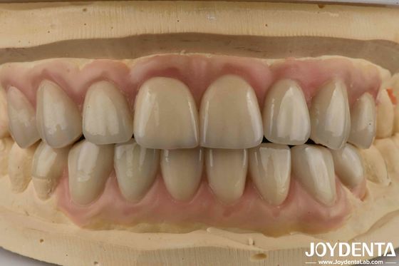 kopen Hoogtranslucentie Emax Cosmetische tandheelkunde Veneers Hoog esthetisch Ultra dun online vervaardiging