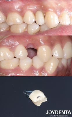 kopen All On 4 tandheelkundige tandheelkundige implantaten cilindrische vorm Titan tandheelkundige implantaten ruwe oppervlakte online vervaardiging