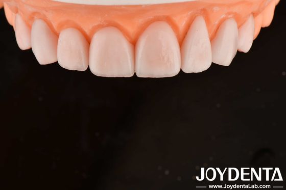 kopen Op maat gemaakte IPS Porselein Emax Veneers Tandheelkundige restauraties Chipping Resistent online vervaardiging
