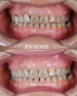 kopen Lichte tandheelkundige zirconia voor een optimale patiëntbeleving Natuurlijke kleurovergangen en gegarandeerde biocompatibiliteit online vervaardiging