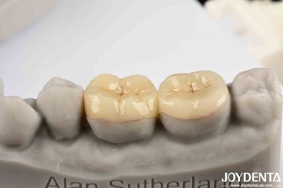kopen Emax Inlay Onlay Precise Fit En Hypoallergene Biocompatibiliteit Makkelijk te reinigen online vervaardiging