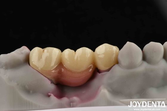 kopen Aanpasbare tandheelkundige implantaten ondersteunde brug en kroon voor tandheelkundige implantaten online vervaardiging