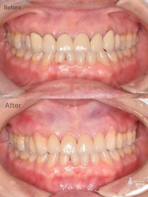 kopen Hoge breukbestendigheid tandheelkundige zirconia voor veilig mondweefsel en CAD / CAM compatibiliteit online vervaardiging