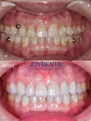 kopen Tandheelkundige veneers voor ontbrekende tanden. Global Premium Dental Lab Services online vervaardiging